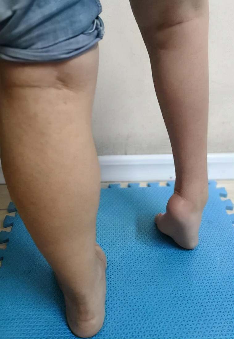 脸部肌肉痉挛怎么自我恢复,肌肉痉挛怎么消除最快