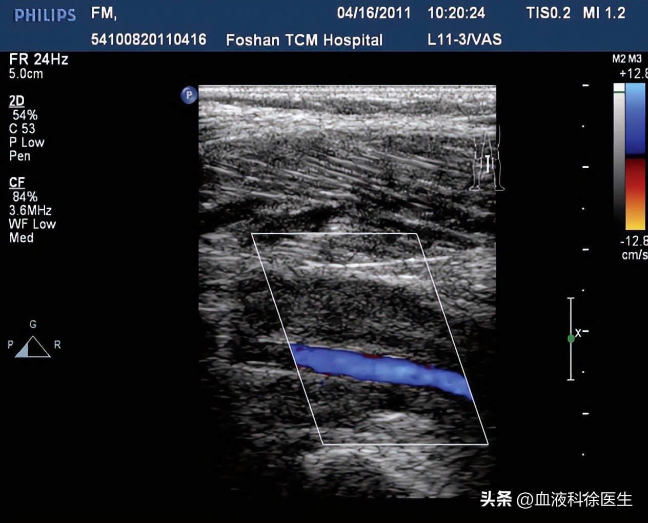 血栓手脚有什么症状和预兆,血栓来临手脚有啥感觉