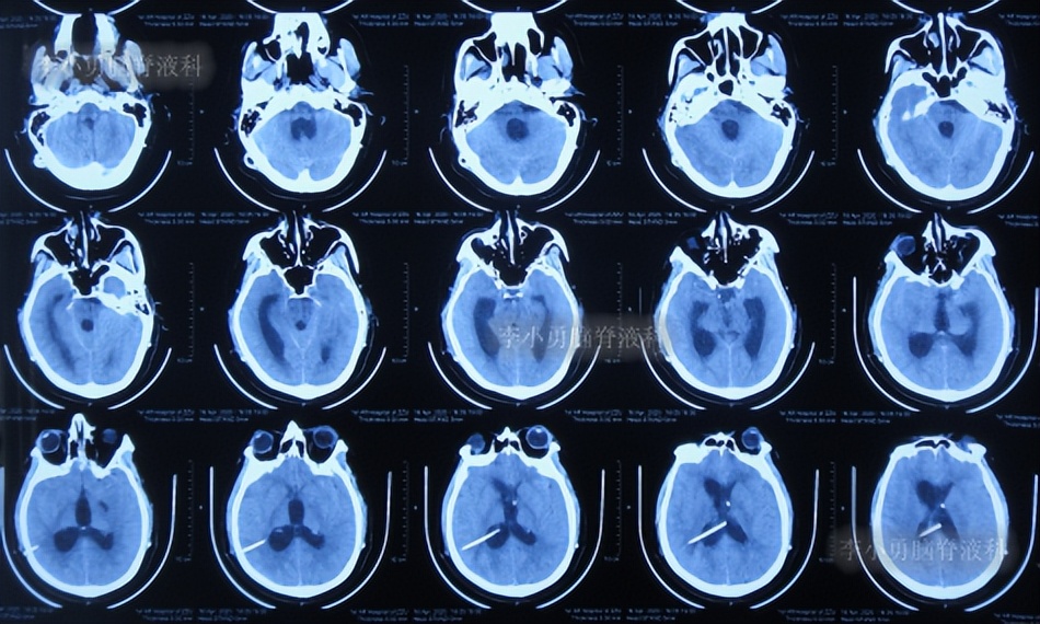 脑积水三脑室造瘘多久能恢复,脑囊虫手术后脑积水