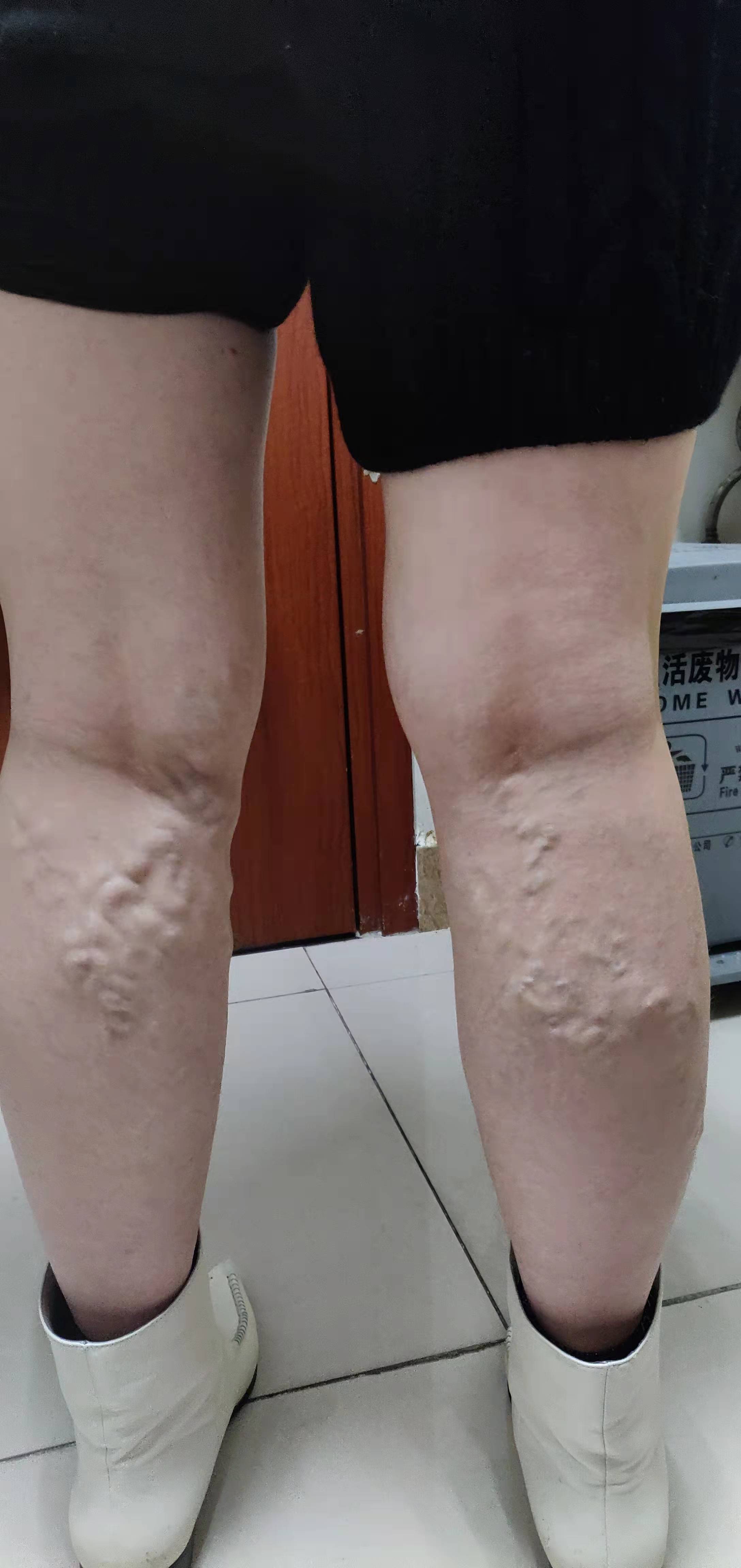 静脉曲张用银针刺是怎么治疗的,北京静脉曲张针刺疗法