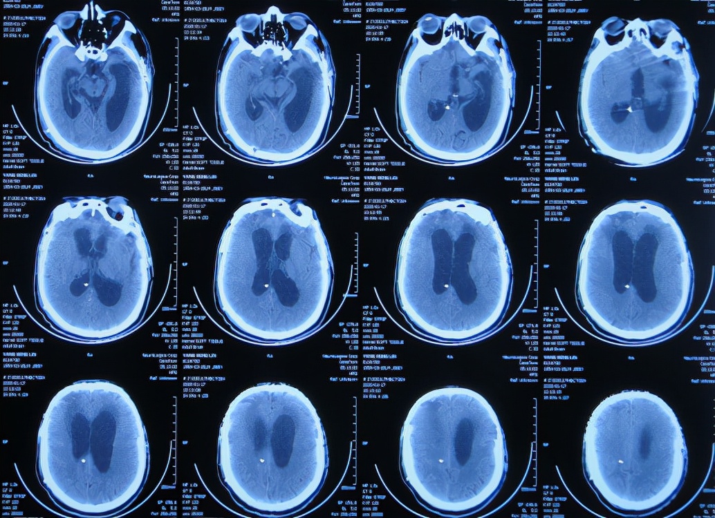 脑外伤后硬膜下积液颅骨修补,颅骨修复手术失败导致脑积水