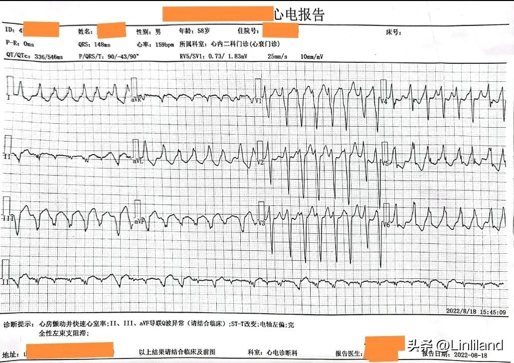 过速性房颤治疗,持续性房颤心动过速