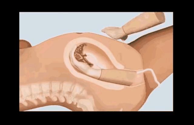 生孩子剖腹产与顺产对比,生孩子顺产和剖腹产对比