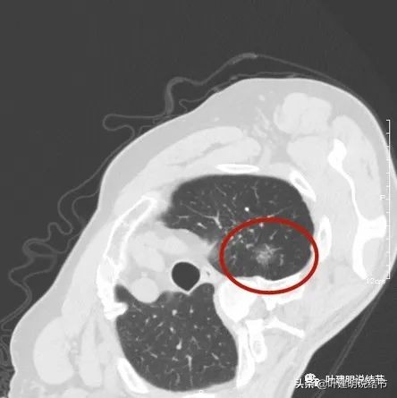 肺多发结节切除一个剩下的怎么办,无限纠结的肺小结节
