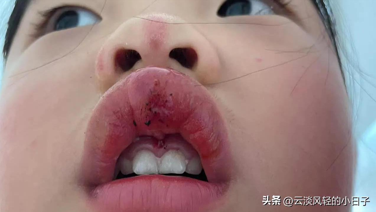小孩在幼儿园摔断了唇系带,这个伤口好尴尬!