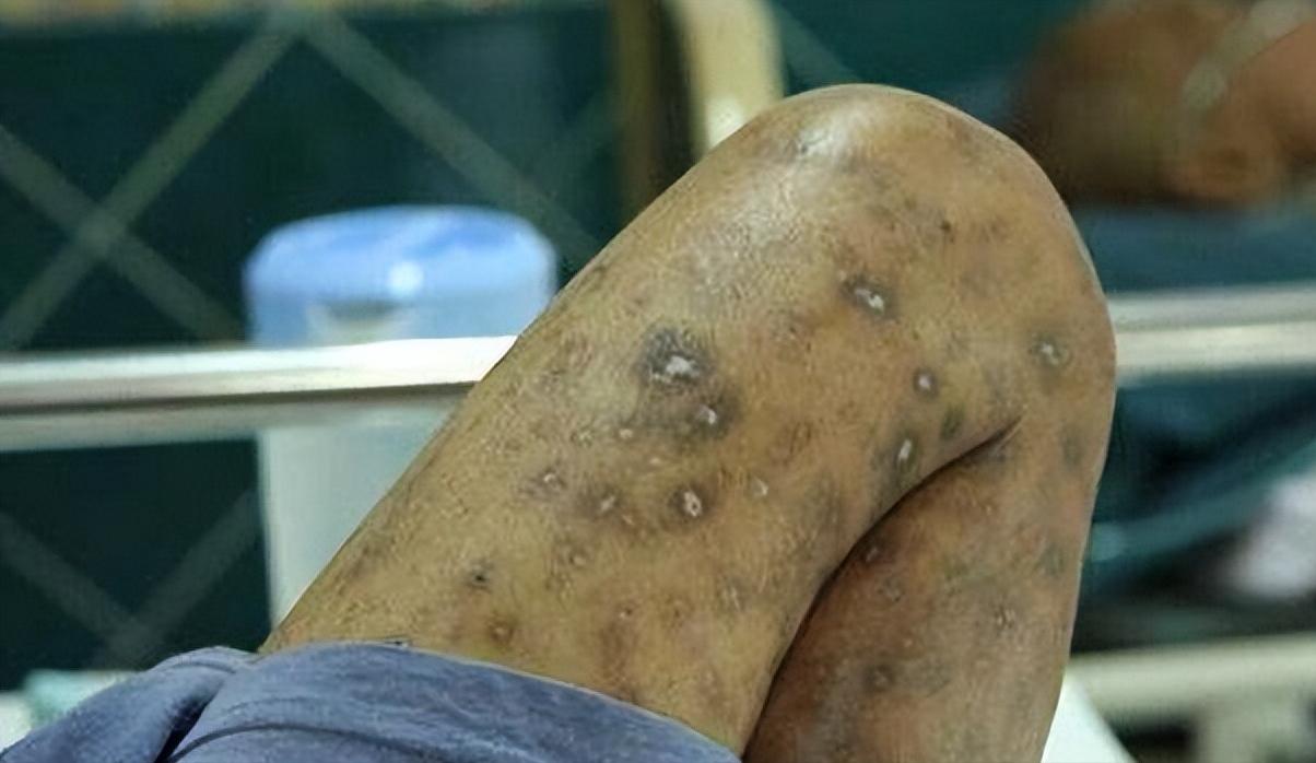 为什么男性会选择嫖娼？医生：嫖娼传播5种性病，私生活别太放纵