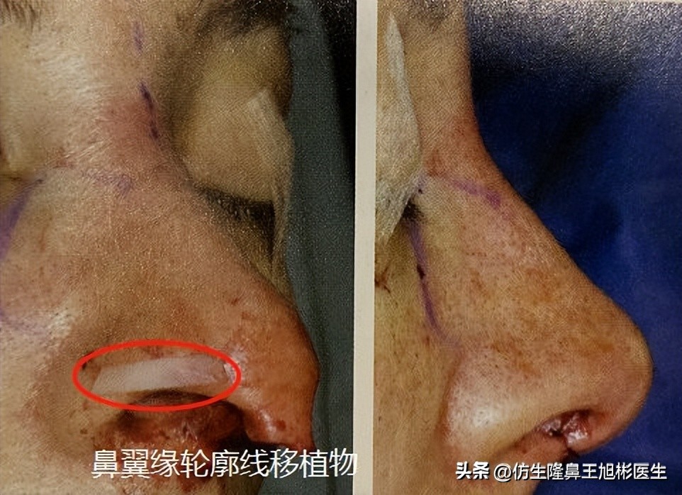 隆鼻的鼻翼怎么修复,隆鼻后多久可以做鼻翼缘矫正