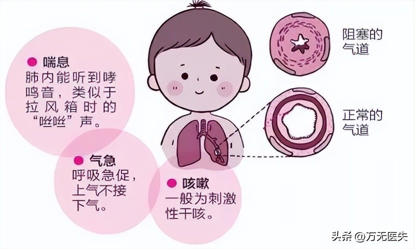 青少年运动后哮喘的治疗方法,儿童哮喘和成人哮喘治疗一样吗