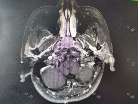鼻咽癌是年轻还是年老的容易复发,鼻咽癌治愈半年了还有浓鼻涕