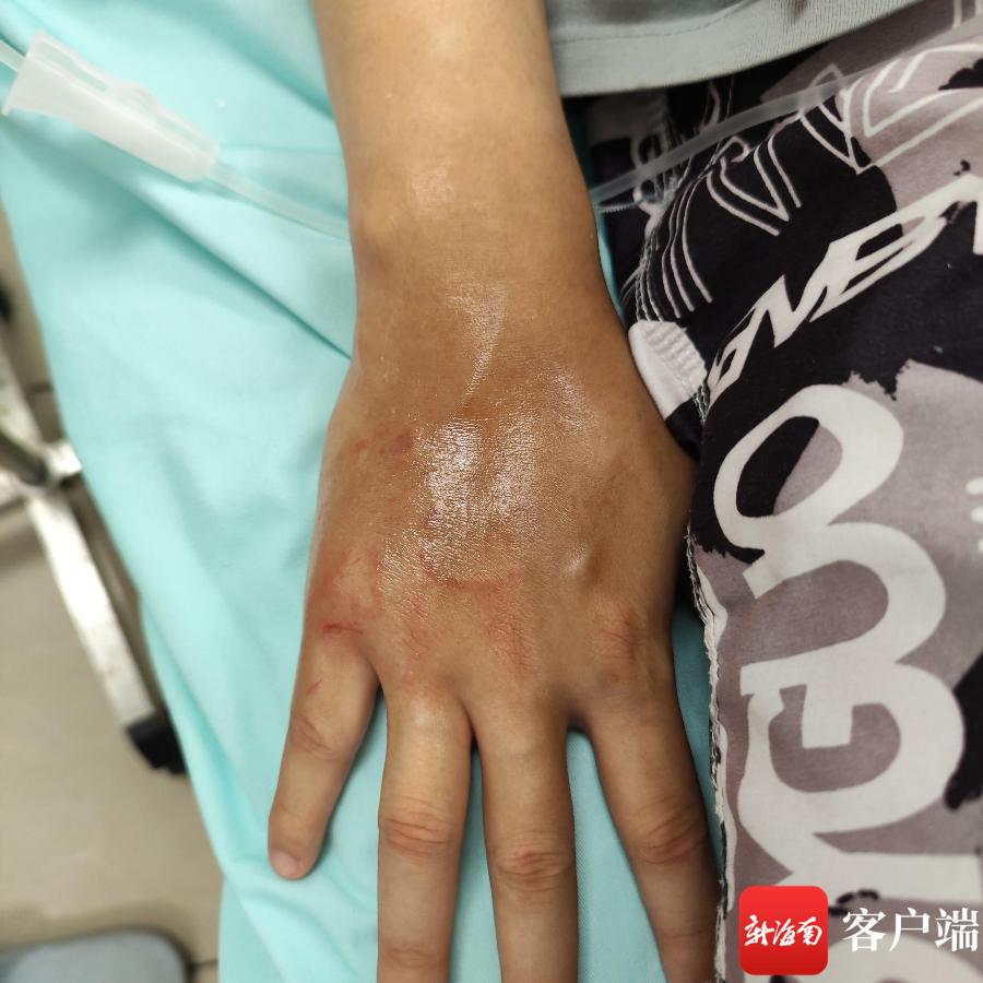 游客下海玩水被水母蛰伤海南急诊科医生：水母蜇伤注意这四点