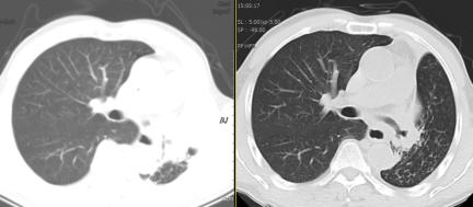 内镜下良性肿瘤切除术,手术切除恶性肿瘤的正确方法