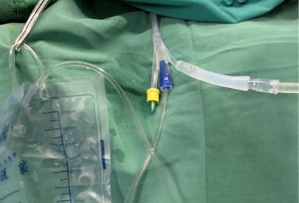 前列腺增生激光剜除术,四川华西钬激光前列腺剜除术过程