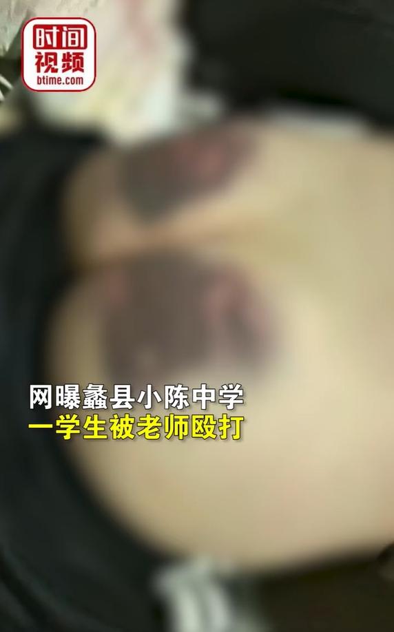 快评丨学生屁股被打成黑紫色，严师不是“严”于体罚之师