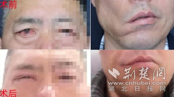 面瘫后遗症15年可以恢复正常吗,面瘫后遗症二十年了一笑嘴还是歪