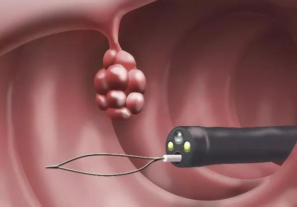 肠镜检查需要注意哪些方面的问题,肠镜检查的注意点