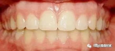 儿童早期牙齿矫正华西,华西口腔小孩矫正牙齿是什么科