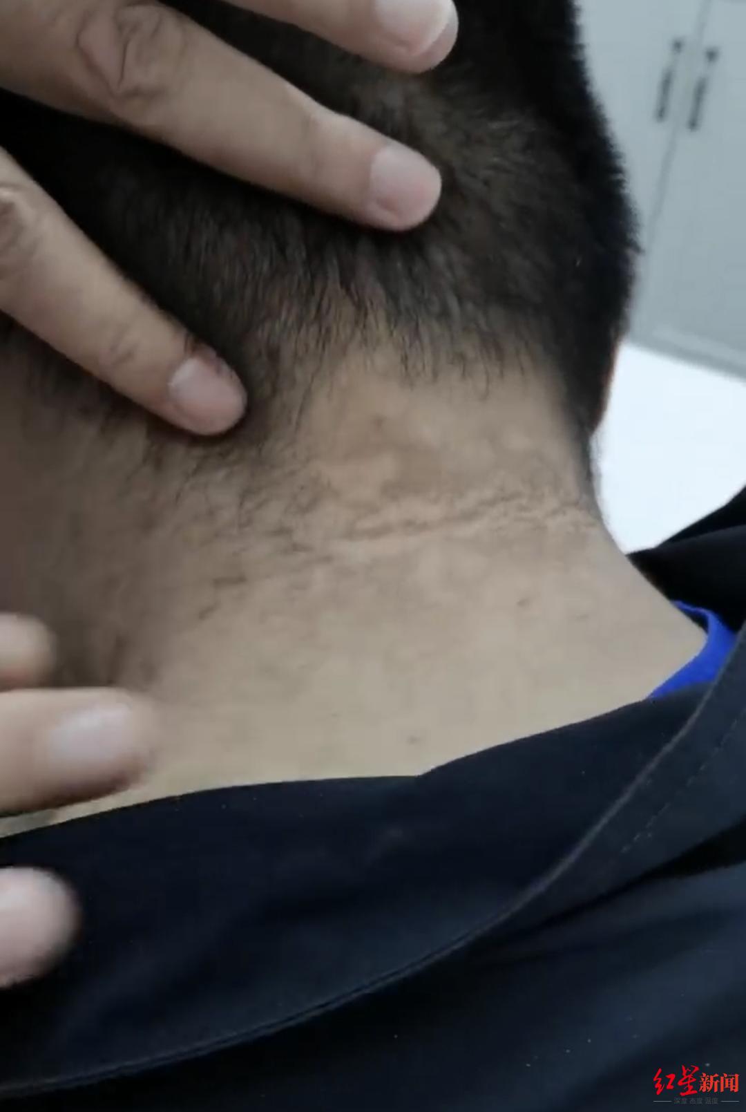 瘦子脖子黑棘皮是什么原因引起的,人瘦了脖子上的黑棘皮怎么去除