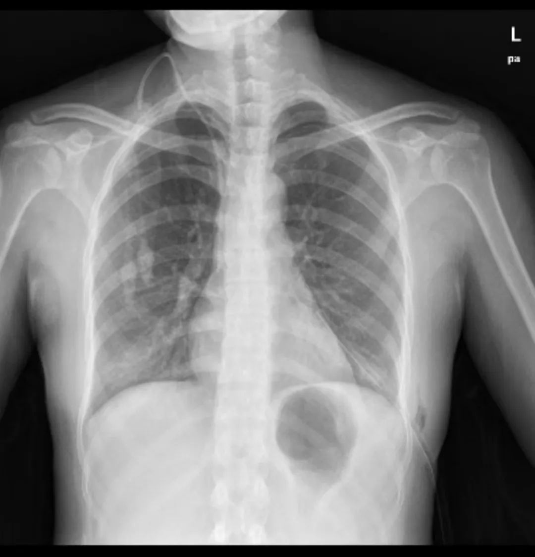从楼梯摔下来腰椎间盘突出,医院女孩从楼梯摔下来