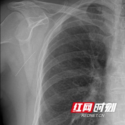 株洲市三三一医院：绣花针为何扎入背部小孙子竟是“刺客”