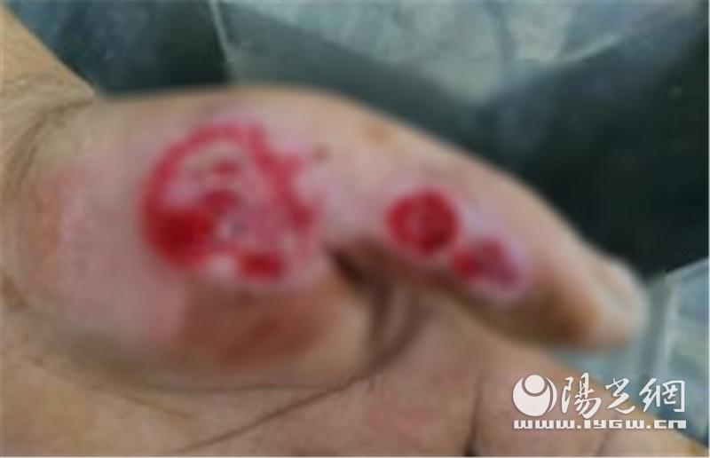 实验室强酸烧伤,化学实验室酸烧伤