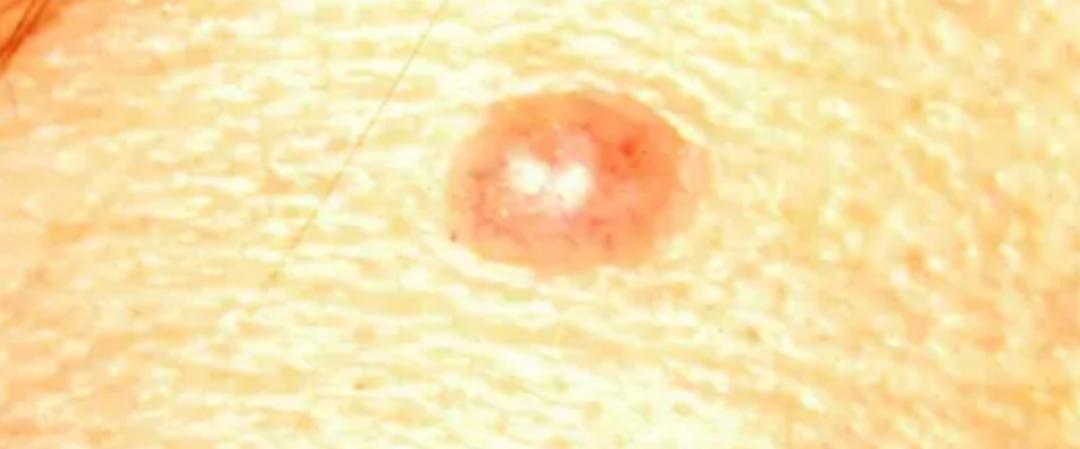 痣科普视频,科普有痣者的困扰正确认识色素痣