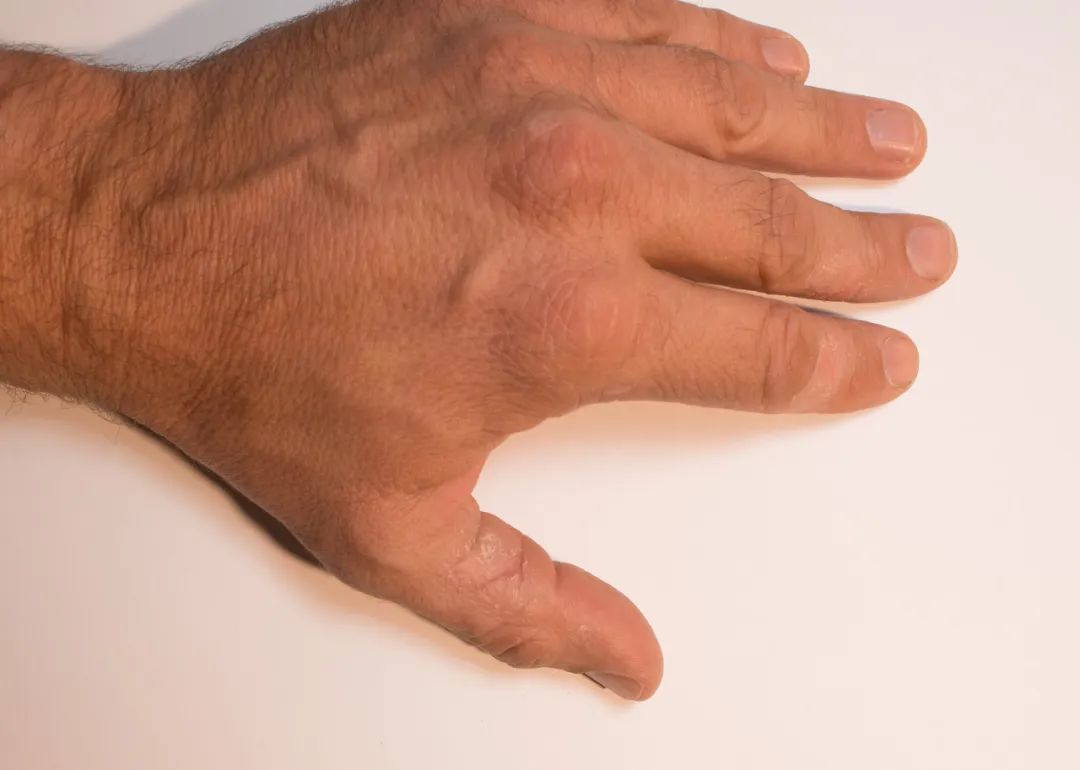 生气时手麻脚麻是什么症状,面麻手麻脚麻是什么病的症状