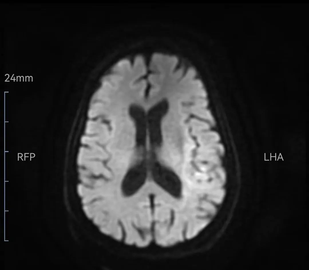 西安脑梗取栓康复医院,西安市第三医院脑卒中急救