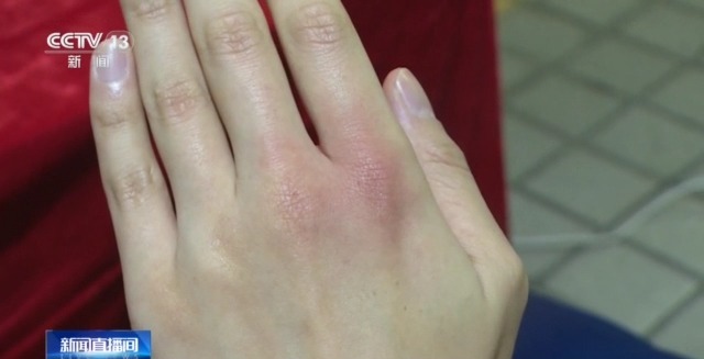 取暖神器有风险寒冬谨防低温烫伤,取暖器低温烫伤怎么处理