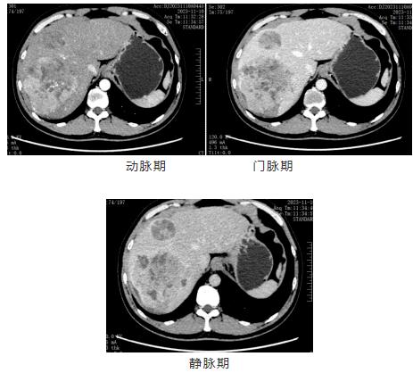 阳光融和医院普外一科顺利完成复杂巨大肝脏肿瘤切除术，为患者赢得生机